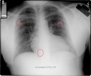 R Cain Discovered Chest Xray 2008_Implants Circled